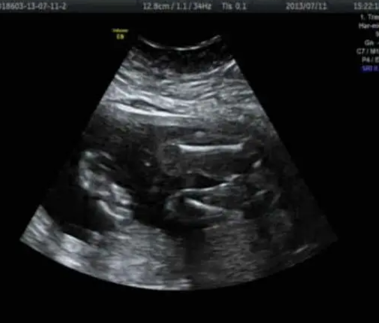 新生New Born格鲁吉亚试管婴儿什么是捐卵辅助生育